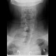 Cervical rib, megatransverse process, unilateral: X-ray - Plain radiograph